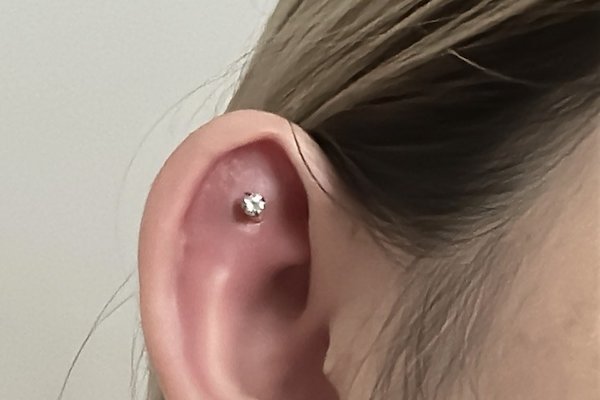 Nhận biết lỗ xỏ khuyên tai bị sưng viêm nặng