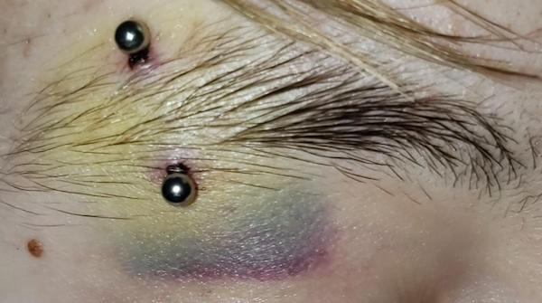 Lỗ xỏ khuyên bị bầm tím lăn trứng gà được không?