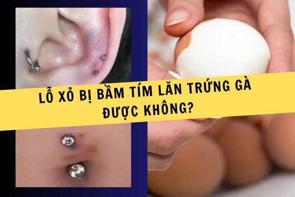 Lỗ xỏ khuyên bị bầm tím lăn trứng gà được không?