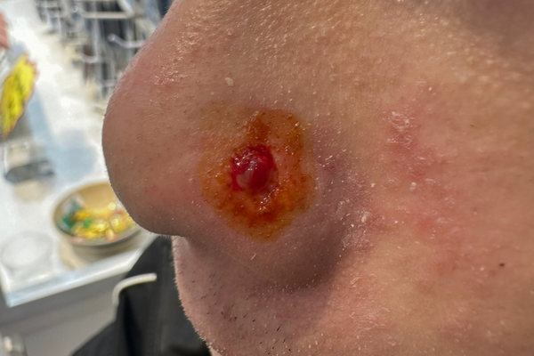 Miệng lỗ xỏ khuyên bị lở có sao không