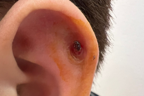 Miệng lỗ xỏ khuyên bị lở có sao không