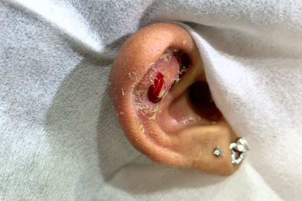 Mới bấm lỗ tai đeo vàng được không?