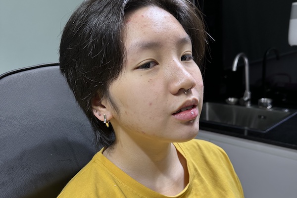 Môi tiêm filler có xỏ khuyên miệng được không?