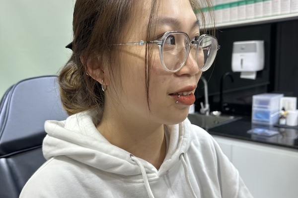 Môi tiêm filler có xỏ khuyên miệng được không?