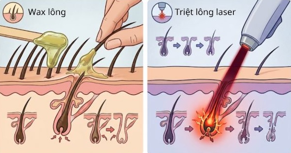 nên chọn phương pháp triệt lông laser hay wax lông