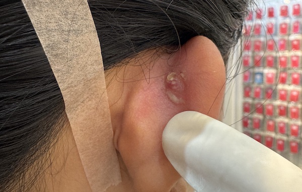 Nhét tỏi vào lỗ xỏ khuyên được không?