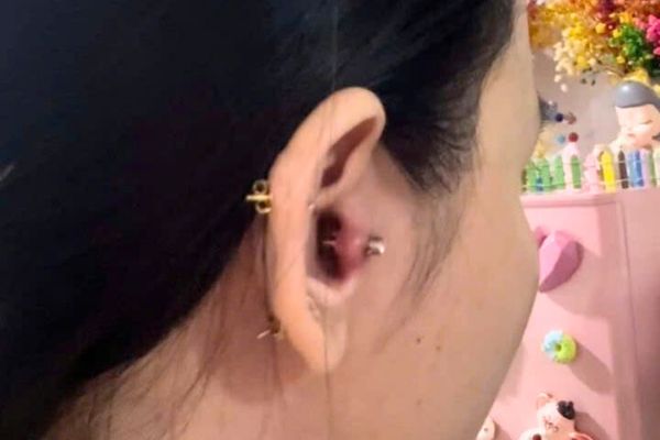Nhiễm trùng sau khi bấm lỗ tai ở giới trẻ