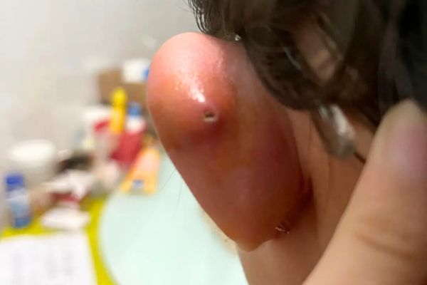 Nhiễm trùng sau khi bấm lỗ tai ở giới trẻ