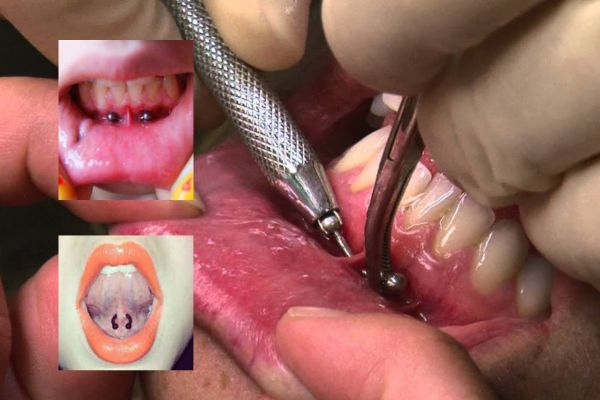 Niềng răng xỏ khuyên smiley được không?