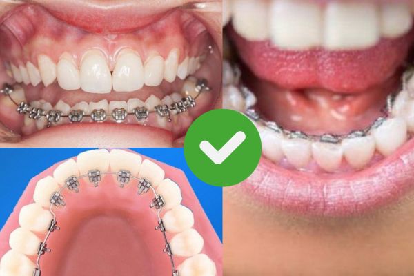 Niềng răng xỏ khuyên smiley được không?