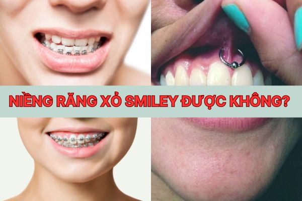 Niềng răng xỏ khuyên smiley được không?