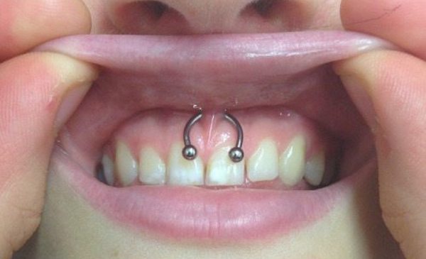 Niềng răng xỏ khuyên smiley được không?