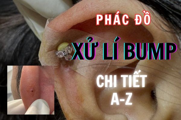 Phác đồ điều trị bump tại TinyBox chi tiết từ A-Z