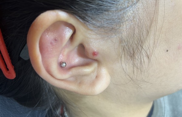 Phác đồ điều trị bump tại TinyBox