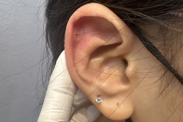 Cách phân biệt lỗ xỏ bị phồng và bị bump trong xỏ khuyên