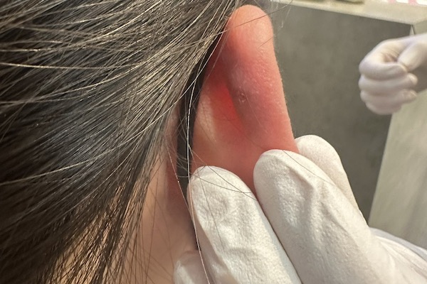 Cách phân biệt lỗ xỏ bị phồng và bị bump trong xỏ khuyên