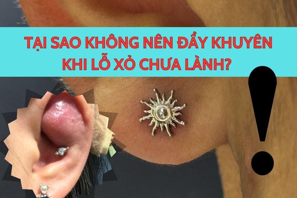 Tại sao không nên đẩy khuyên khi lỗ xỏ chưa lành?