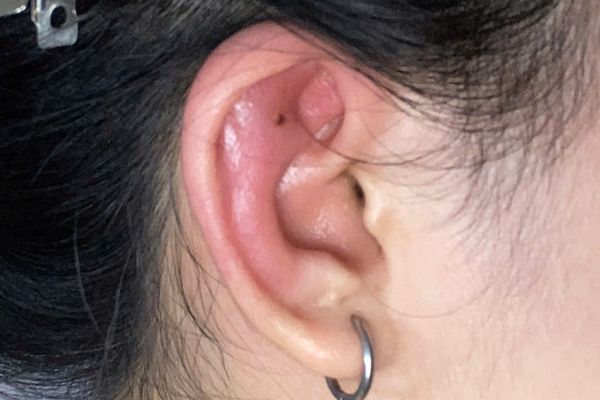 Tại sao không nên đẩy khuyên khi lỗ xỏ chưa lành?