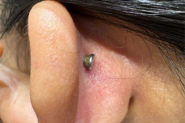 Tại sao không nên đẩy khuyên khi lỗ xỏ chưa lành?