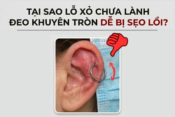 Tại sao lỗ xỏ chưa lành đeo khuyên tròn dễ bị sẹo lồi?