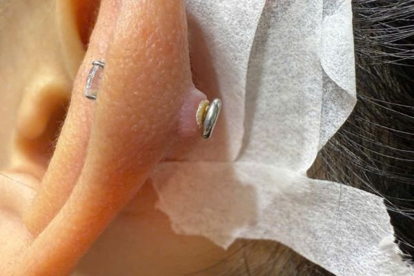Tại sao xỏ khuyên kiêng ăn nhưng vẫn bị bump?