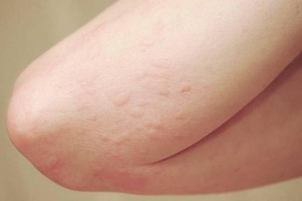 Thuốc ủ tê ảnh hưởng đến lỗ xỏ khuyên không?