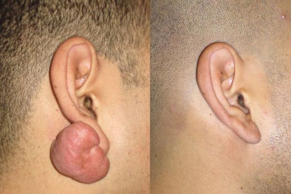 Trị sẹo lồi sau xỏ khuyên uy tín tại TpHCM - TinyBox