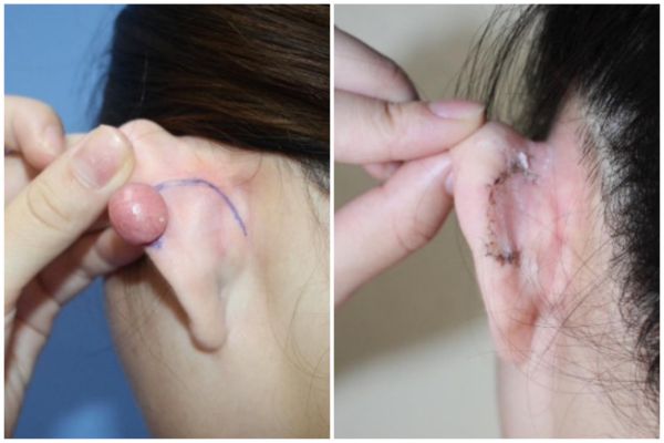 Trị sẹo lồi sau xỏ khuyên uy tín tại TpHCM - TinyBox