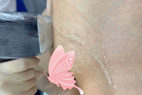 Triệt lông bikini có ngứa như cạo lông truyền thống không?