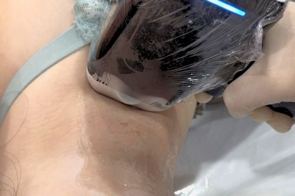 triệt lông laser tại TinyBox - triệt lông nách