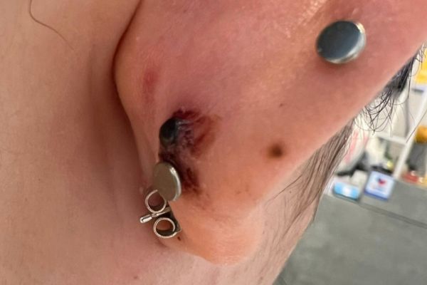 Vệ sinh lỗ xỏ khuyên đến khi nào?