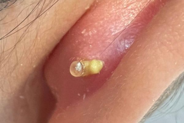 Vệ sinh lỗ xỏ khuyên đến khi nào?