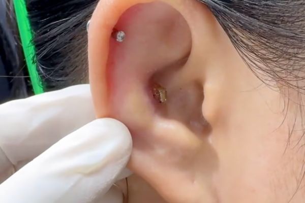 Vệ sinh lỗ xỏ sụn sao cho an toàn, không bị bump?