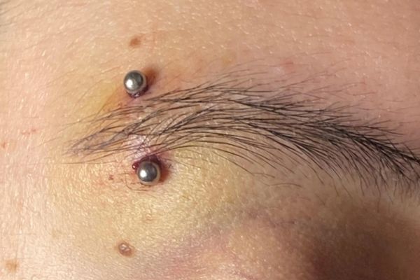 Xỏ chân mày bị bầm tím có sao không? Cách xử lý tại nhà an toàn