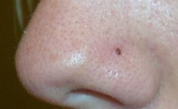 lỗ xỏ khuyên bị đen