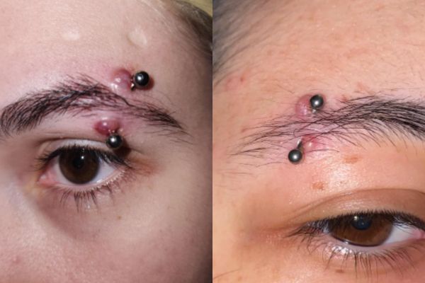 Xỏ khuyên chân mày có để lại sẹo không?