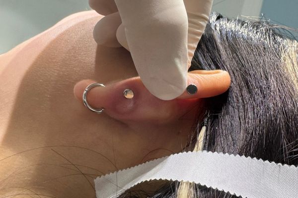 Xỏ khuyên kiêng ăn nhưng vẫn bị sẹo lồi?