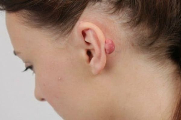 Xỏ khuyên kiêng ăn nhưng vẫn bị sẹo lồi?