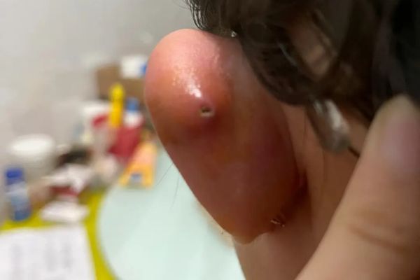 Xỏ khuyên kiêng ăn nhưng vẫn bị sẹo lồi?