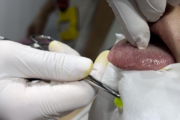 Xỏ khuyên lưỡi về nhà thì bị chảy máu phải làm sao?