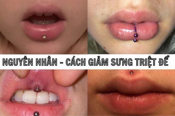 Xỏ khuyên môi bị sưng