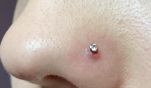 Cách chữa xỏ khuyên mũi bị lồi thịt