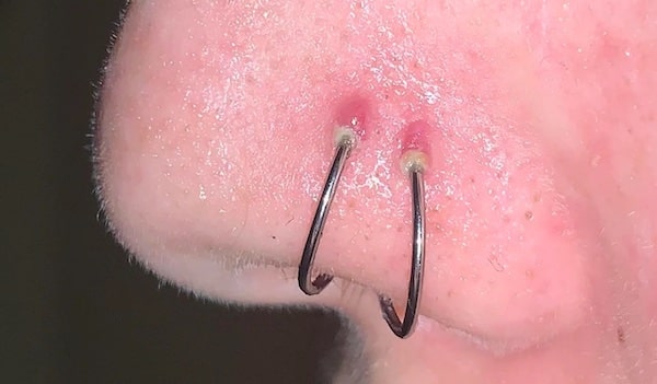 Cách chữa xỏ khuyên mũi bị lồi thịt