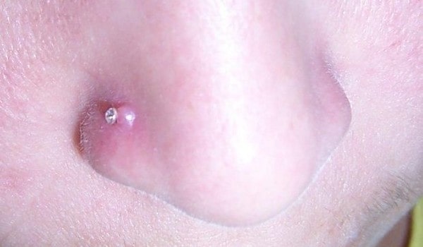 Cách chữa xỏ khuyên mũi bị lồi thịt