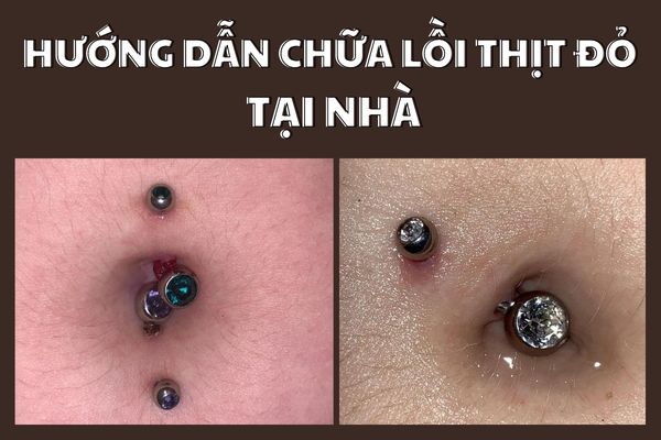 Cách chữa xỏ khuyên rốn bị lồi thịt hiệu quả và đơn giản tại nhà