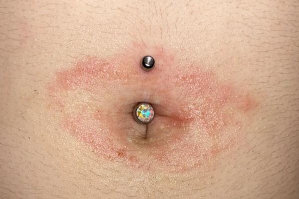 Xỏ khuyên rốn bị ngứa: Nguyên nhân & biện pháp xử lí