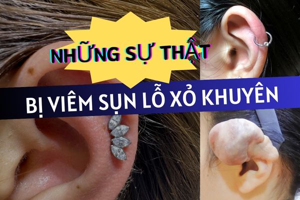 xỏ khuyên tai bị viêm sụn