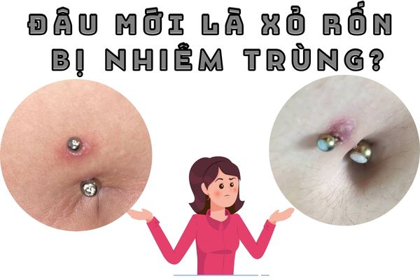 Xỏ rốn bị nhiễm trùng