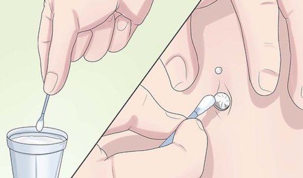 Xỏ rốn bị nhiễm trùng