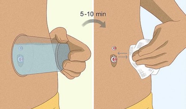 Xỏ rốn bị nhiễm trùng